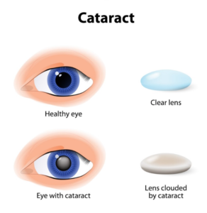 What is Cataract?