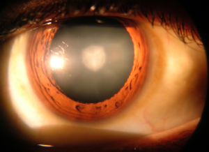Cataract in a human eye