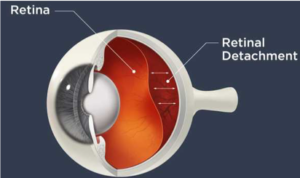 What is Retinal Detachment? Optimum Vision Clinic