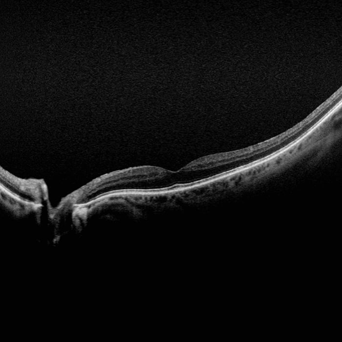 Manufacturer example OCT retinal cross-section beneath a layered illustration