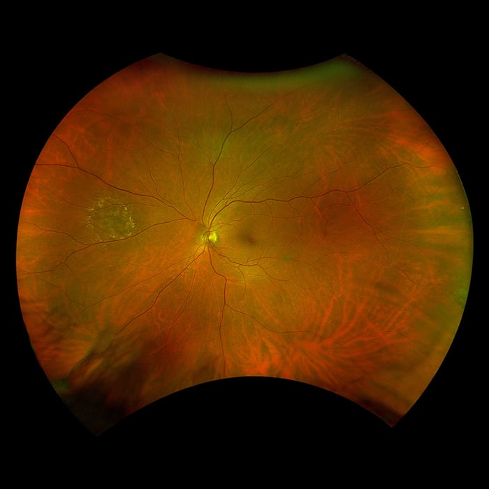 Manufacturer example Optomap ultra-widefield retinal image beneath an illustration